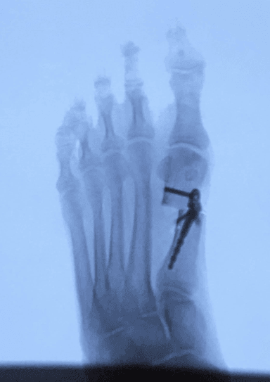 Minimally Invasive Bunionectomy